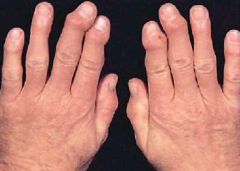 İltihaplanma Nedir ?